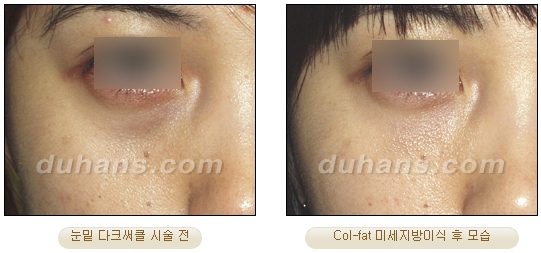 [Duhan Plastic Surgery Facial Autologous Fat Grafting] - [Fat Grafting Guide] image 21