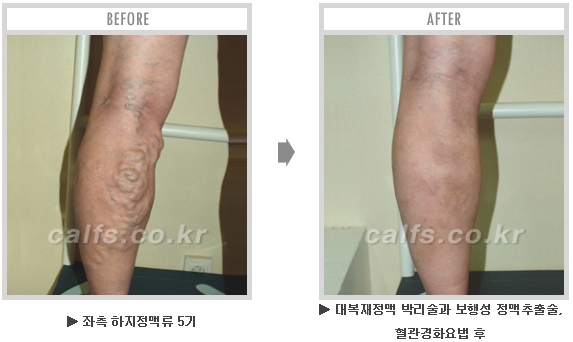 [종아리성형 두한성형외과] - [종아리수술에 대한 자주하는 질문과 답변 모음] 관련 이미지 10