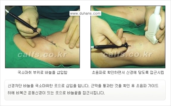 ​[두한성형외과와 날씬한 종아리 만들기!] - [간편하고 안전한 종아리 축소방법 ②] 관련 이미지 10