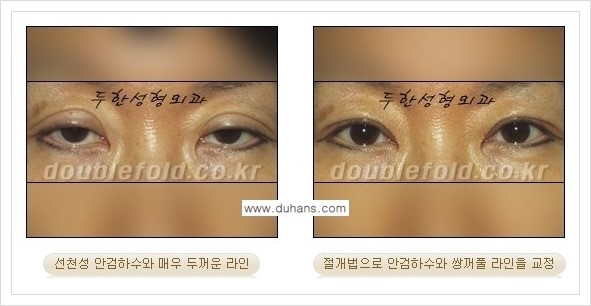 [두한성형외과 경쟁력 쌍꺼풀 재수술, 극한 재수술] - [안검하수(졸린눈매) 교정 방법 안내] 관련 이미지 7