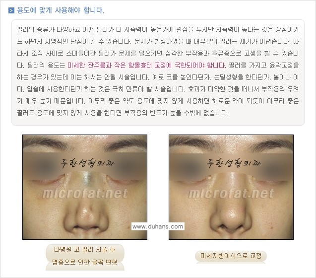 [두한성형외과 경쟁력 퀵성형] - [필러주사(쥬비덤)으로  간단하고 빠르게 주름교정] 관련 이미지 18
