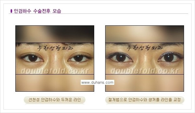 [두한성형외과 경쟁력  쌍꺼풀 재수술] - [안검하수(졸리운 눈매) 수술 전후 모습 안내] 관련 이미지 1