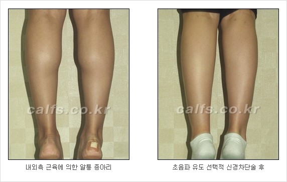 [두한성형외과 경쟁력 종아리성형] - [초음파 유도 선택적 신경차단술 안내 ④] 관련 이미지 8
