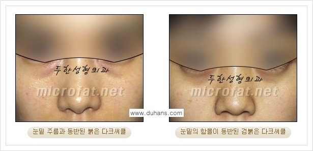 [두한성형외과 경쟁력 눈밑성형] - [눈밑 다크써클, 눈밑 주름의 교정 안내 1.] 관련 이미지 4