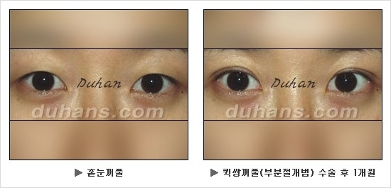 [두한성형외과 쌍커풀수술] - [눈성형 방법에 대한 자주하는 질문과 답변] 관련 이미지 115