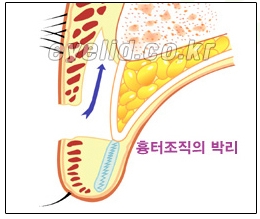 [두한성형외과 쌍꺼풀재수술] - [쌍꺼풀재수술성공요건, 쌍꺼풀재수술과정] 관련 이미지 12