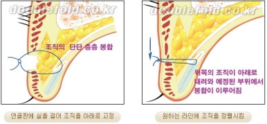 [Duhan Plastic Surgery Reoperation for Double Eyelids] - [Lowering the Double Eyelid Line] image 35