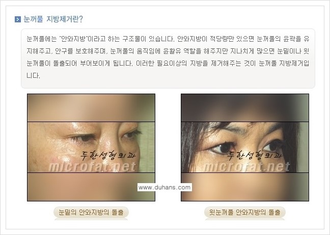[두한성형외과 경쟁력 눈밑성형] - [눈밑지방제거, 눈위지방제거 안내 1.] 관련 이미지 1