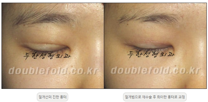 [Double Eyelid Surgery Duhan Plastic Surgery] - [Revision Methods] image 40