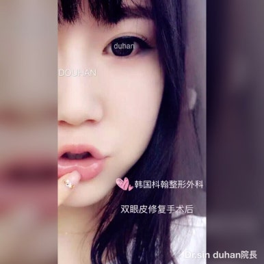 Best Place for Double Eyelid Revision Surgery, Duhan Plastic Surgery - Partial Incision Eye Revision Surgery image 49