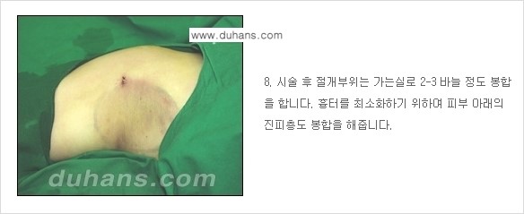 [두한성형외과 성형 FOCUS 지방흡입] - [액취증 - 다한증 초음파 컷터 지방흡입 ④] 관련 이미지 9