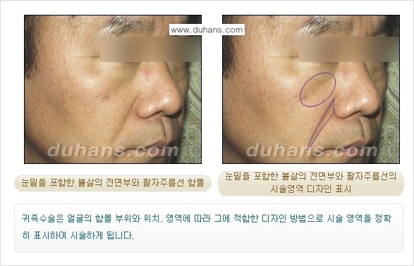 [두한성형외과 입체적이고 볼륨있는 얼굴 만들기] - [귀족수술 - 입체지방이식 1.] 관련 이미지 8