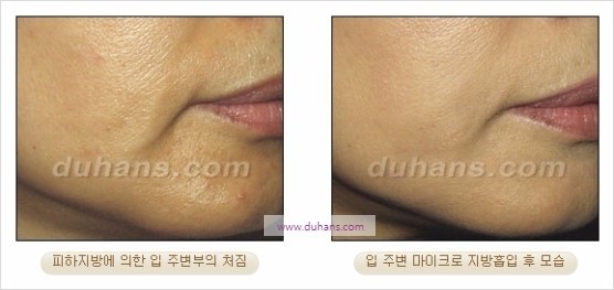 [두한성형외과 경쟁력 지방흡입] - [볼살, 턱선의 간편 지방흡입] 관련 이미지 25