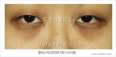 [두한성형외과 경쟁력 눈밑성형] - [다크써클의 원인과 다크써클의 종류] 관련 이미지 13