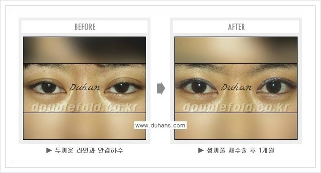 [두한성형외과 경쟁력 쌍꺼풀 재수술, 극한 재수술] - [과한 눈매교정 안내] 관련 이미지 3