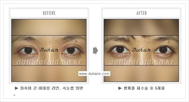 [두한성형외과 경쟁력 쌍꺼풀 재수술] - [과도한 앞트임이 되었을 경우 안내] 관련 이미지 5