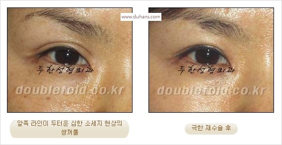 [두한성형외과 경쟁력 쌍꺼풀 재수술 스페셜] - [망가진 라인을 교정하는 극한 재수술] 관련 이미지 5