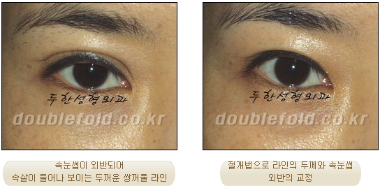 [두한성형외과 쌍커풀수술] - [눈성형 방법에 대한 자주하는 질문과 답변] 관련 이미지 57