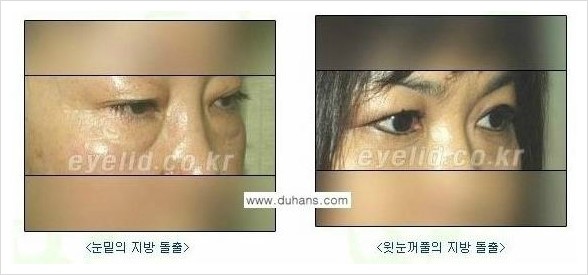 [두한성형외과 경쟁력 안검성형] - [젊은 눈매 안검성형의 여러 가지 방법 안내] 관련 이미지 98