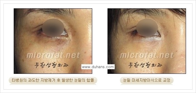 [두한성형외과 경쟁력 지방제거] - [눈밑(눈위)지방제거, 눈꺼풀(윗눈꺼풀)지방제거 안내 ②] 관련 이미지 3