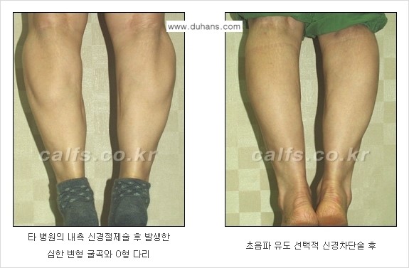 ​[두한성형외과와 날씬한 종아리 만들기!] - [간편하고 안전한 종아리 축소방법 ④] 관련 이미지 15
