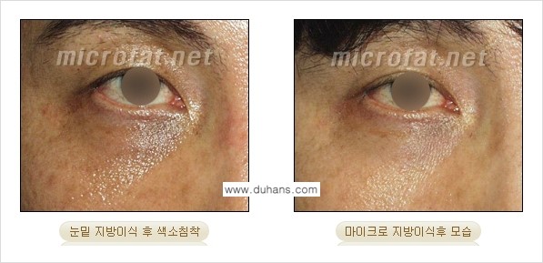 [두한성형외과 경쟁력 미세지방이식] - [미세지방이식 부작용 교정] 관련 이미지 2