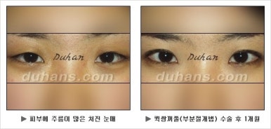 Best Place for Double Eyelid Revision Surgery, Duhan Plastic Surgery - Partial Incision Eye Revision Surgery image 25