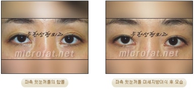 [Doohan Plastic Surgery Autologous Fat Grafting] - [Sunken Eye Fat Grafting] image 38