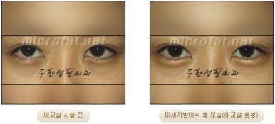 두한성형외과 눈밑성형 - 애교필러 후 눈밑재수술 관련 이미지 31