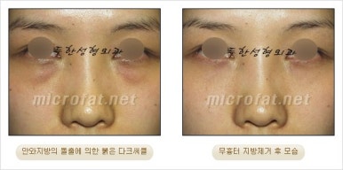 두한성형외과 눈밑수술 - 다크서클 수술 전후 관리 안내 관련 이미지 65