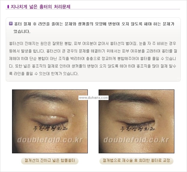 [두한성형외과 경쟁력 쌍꺼풀 재수술, 극한 재수술] - [쌍꺼풀 재수술, 극한 재수술 시 문제점 안내] 관련 이미지 2