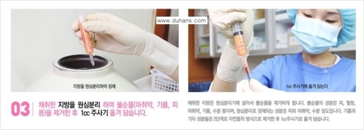 [두한성형외과 FOCUS 눈밑성형] - [다크써클의 치료방법 -  콜펫(Col-fat) 눈밑 미세지방이식 ③] 관련 이미지 8