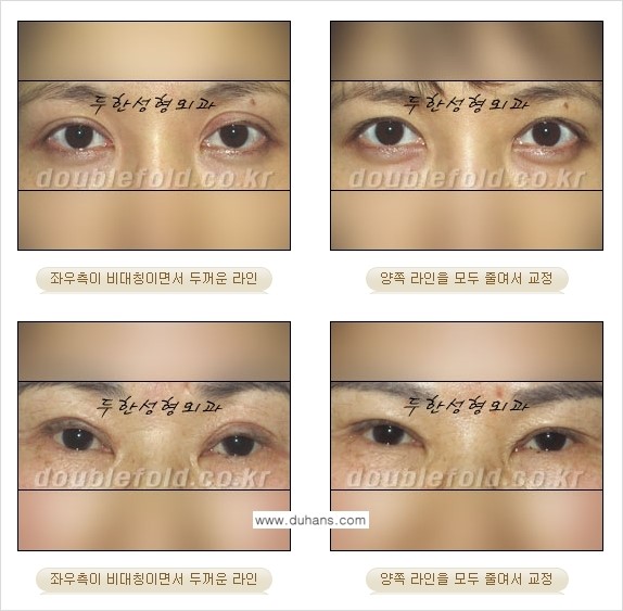 [두한성형외과 경쟁력 눈성형] - [비대칭(짝짝이) 쌍꺼풀 라인 교정 안내 ②] 관련 이미지 5