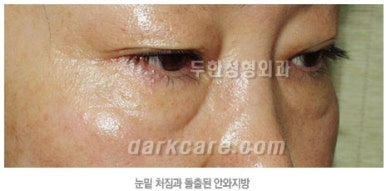 [두한성형외과 다크서클] - [하안검성형술] 관련 이미지 5