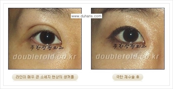 [두한성형외과 경쟁력 쌍꺼풀 재수술] - [극한의 상태에서 쌍꺼풀 재수술 안내 ②] 관련 이미지 10