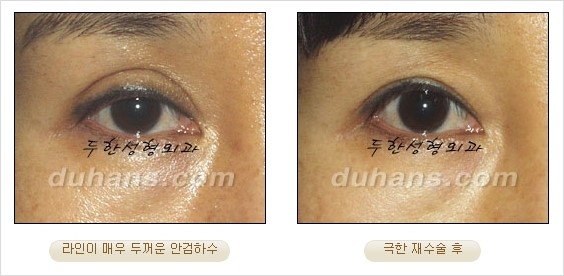 [두한성형외과 경쟁력 쌍꺼풀 재수술 리더 ] - [쌍꺼풀 재수술 과정, 쌍꺼풀 재수술 실패의 원인, 극한 재수술] 관련 이미지 24