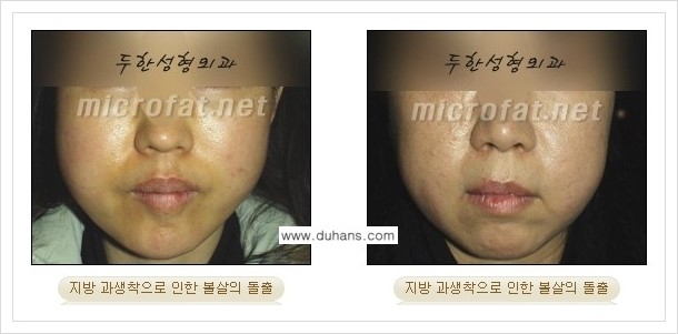 [두한성형외과 경쟁력 지방이식] - [미세지방이식, 자가지방이식, 지방주입의 잘못된 정보 안내] 관련 이미지 5