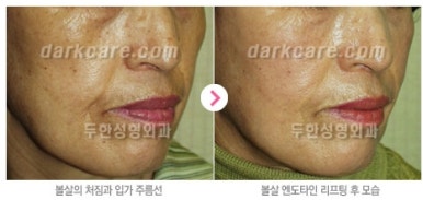 [눈밑수술 두한성형외과] - [다크서클 콤비프로그램] 관련 이미지 133