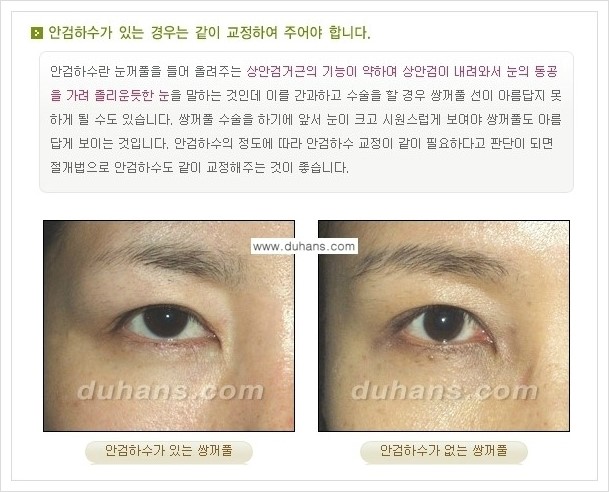 [두한성형외과 경쟁력 눈성형] - [아름답고 자연스러운 눈매, 매력적인 쌍꺼풀 안내] 관련 이미지 6