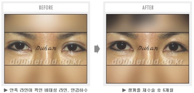 두한성형외과 쌍커풀 재수술 - 짝눈 눈매교정, 가성 안검하수 교정과 뒤밑트임 관련 이미지 40
