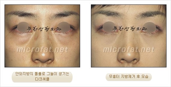 [두한성형외과 쌍커풀수술] - [눈성형 방법에 대한 자주하는 질문과 답변] 관련 이미지 182