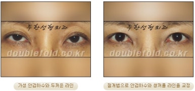 [Duhan Plastic Surgery Double Eyelid Revision Surgery] - [Ptosis, sausage eyelids] image 23