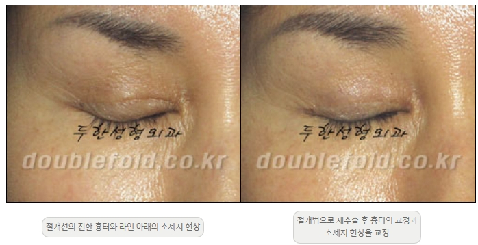 [Double Eyelid Surgery Duhan Plastic Surgery] - [Revision Methods] image 39