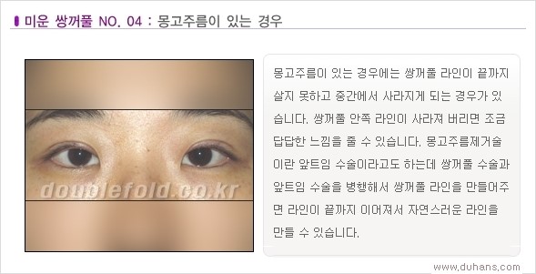 [두한성형외과 경쟁력 쌍꺼풀 재수술, 극한 눈재수술] - [Dr. 컬럼 - 재수술의 목표] 관련 이미지 7