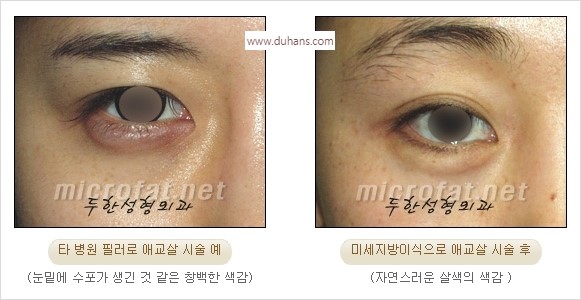 [두한성형외과 경쟁력 눈밑성형] - [눈밑애교살 시술을 위한 미세지방이식] 관련 이미지 13
