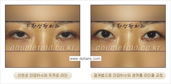 [두한성형외과 경쟁력 눈성형] - [안검하수 수술 방법] 관련 이미지 8