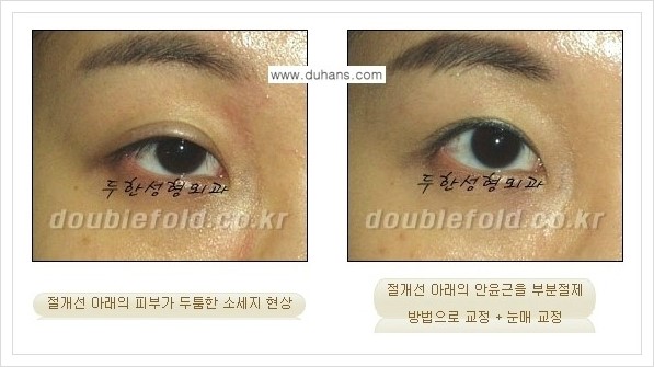 [두한성형외과 경쟁력 쌍꺼풀 재수술, 극한 재수술] - [쌍꺼풀 절개선 아래가 두툼한 소세지 쌍꺼풀의 교정 안내] 관련 이미지 2