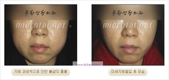 [두한성형외과 경쟁력 지방이식] - [두한 자가지방이식 클리닉 안내]​ 관련 이미지 89