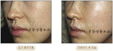 [Duhan Plastic Surgery Face Fat Grafting] - [Reducing Mouth Corners Wrinkles and Nasolabial Folds] image 13