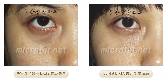 [두한성형외과 경쟁력 지방이식 리더] - [Col-fat(콜펫)지방이식, 3차원 입체지방이식, 2차원 평면지방이식] 관련 이미지 59